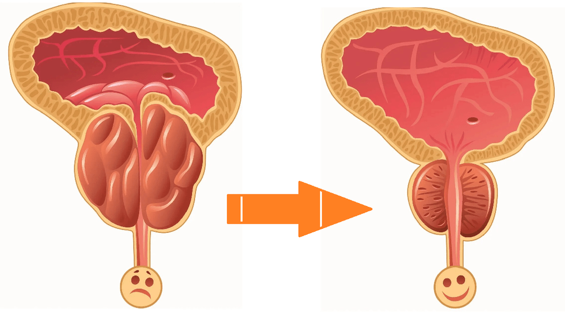 Aktion Uromexil Forte auf Prostata mit Prostatitis und Adenom