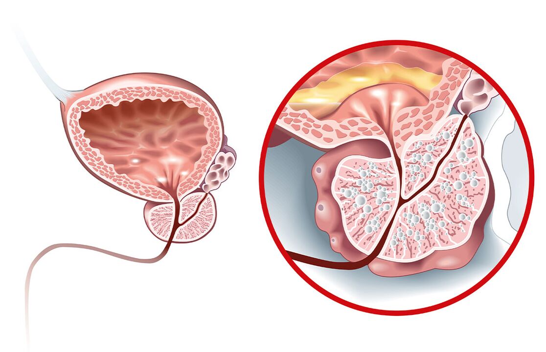 Was passiert mit der Prostata mit Adenom und Prostatitis