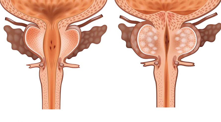Vergleich von gesundem und entzündetem Adenom