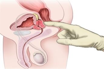 Prostatamassage zur Behandlung chronischer Prostatitis.