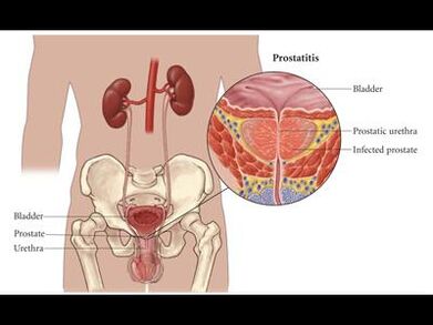 Prostatitis – Entzündung der Prostata